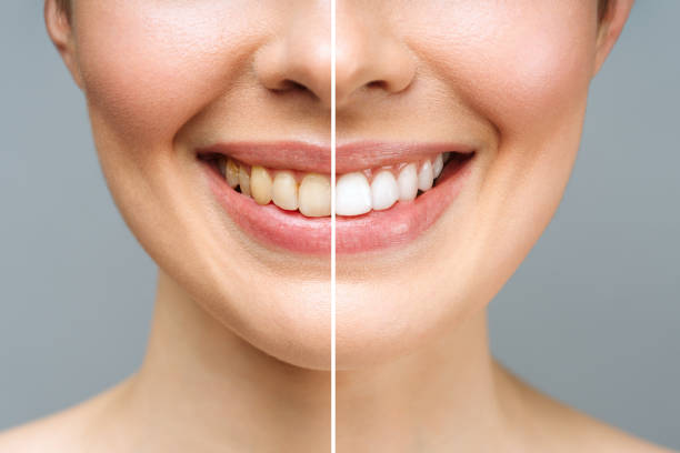 Sbiancamento dentale: metodi, rischi e benefici