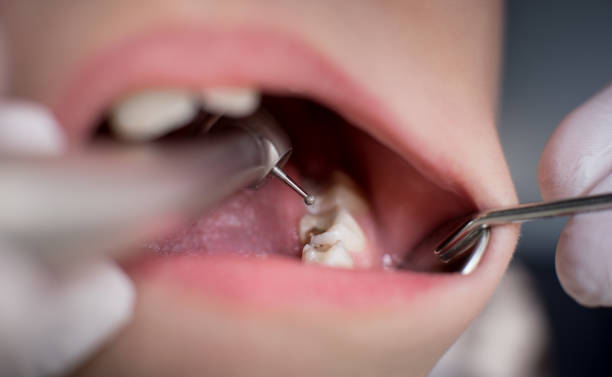 Denti del giudizio: quando è necessario estrarli?