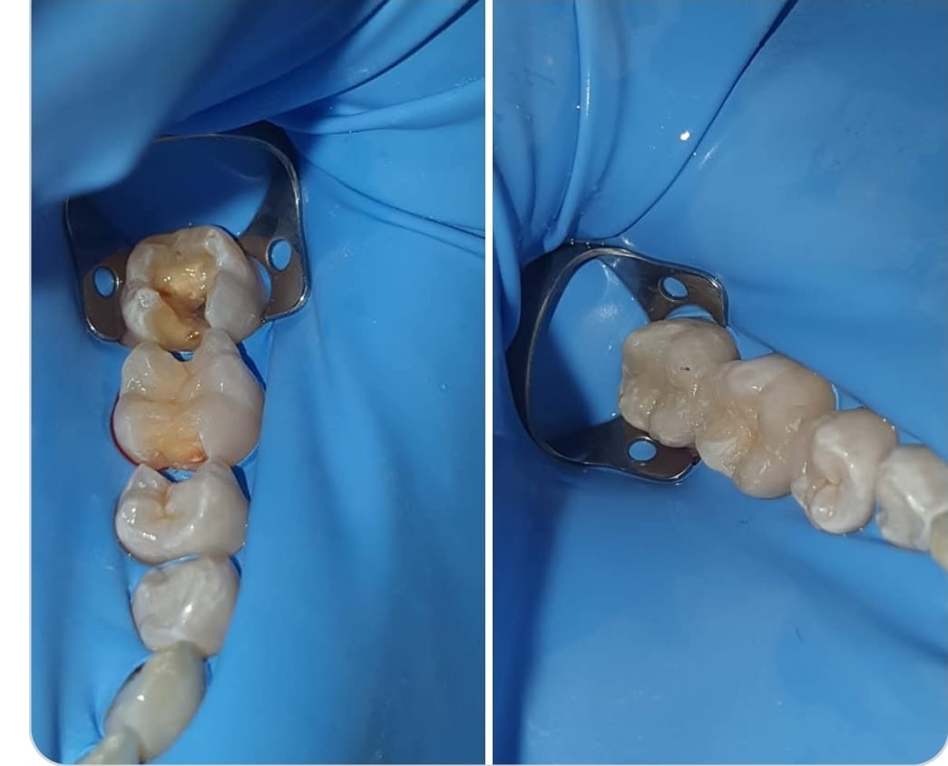 Casi clinici di ricostruzioni dirette