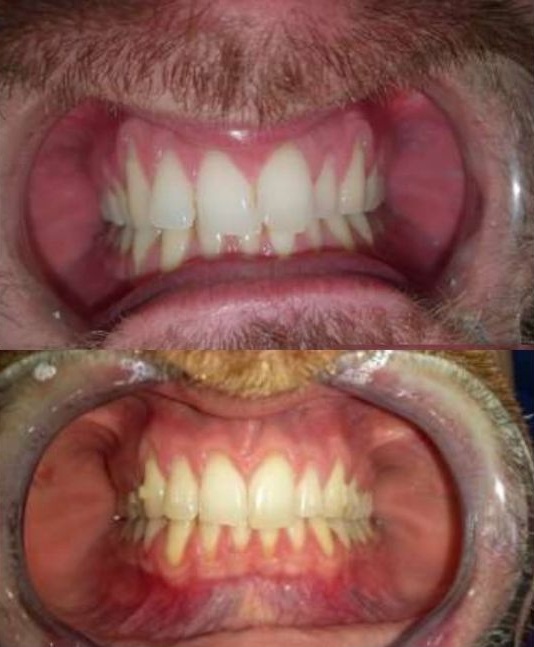 Allineamento e Ricostruzione Dentale