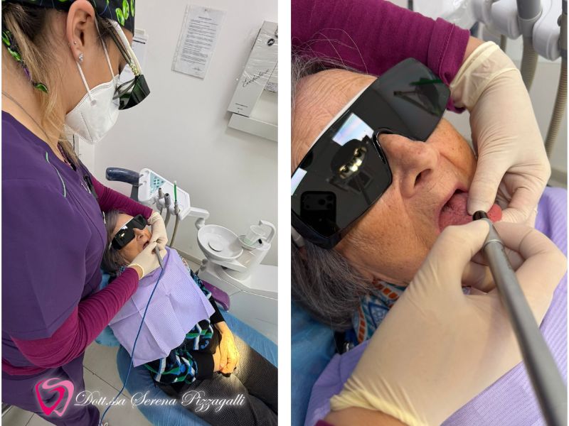 Trattamento di herpes e afte con laser a Giulianova