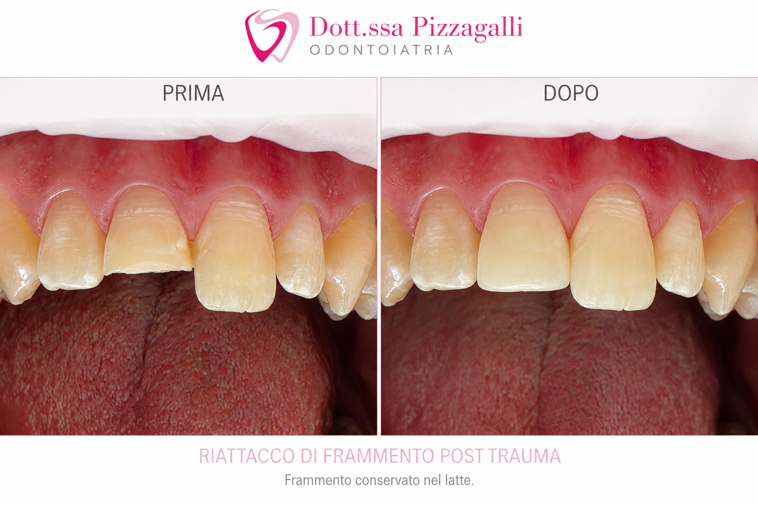 Riattacco Frammento Dente Rotto Post Trauma a Giulianova | Dott.ssa Serena Pizzagalli