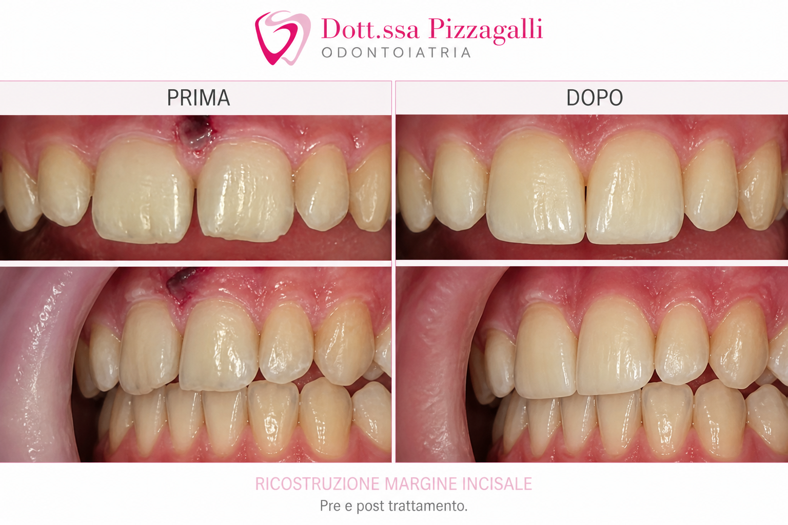 Pre e Post Ricostruzione Margine Incisale a Giulianova