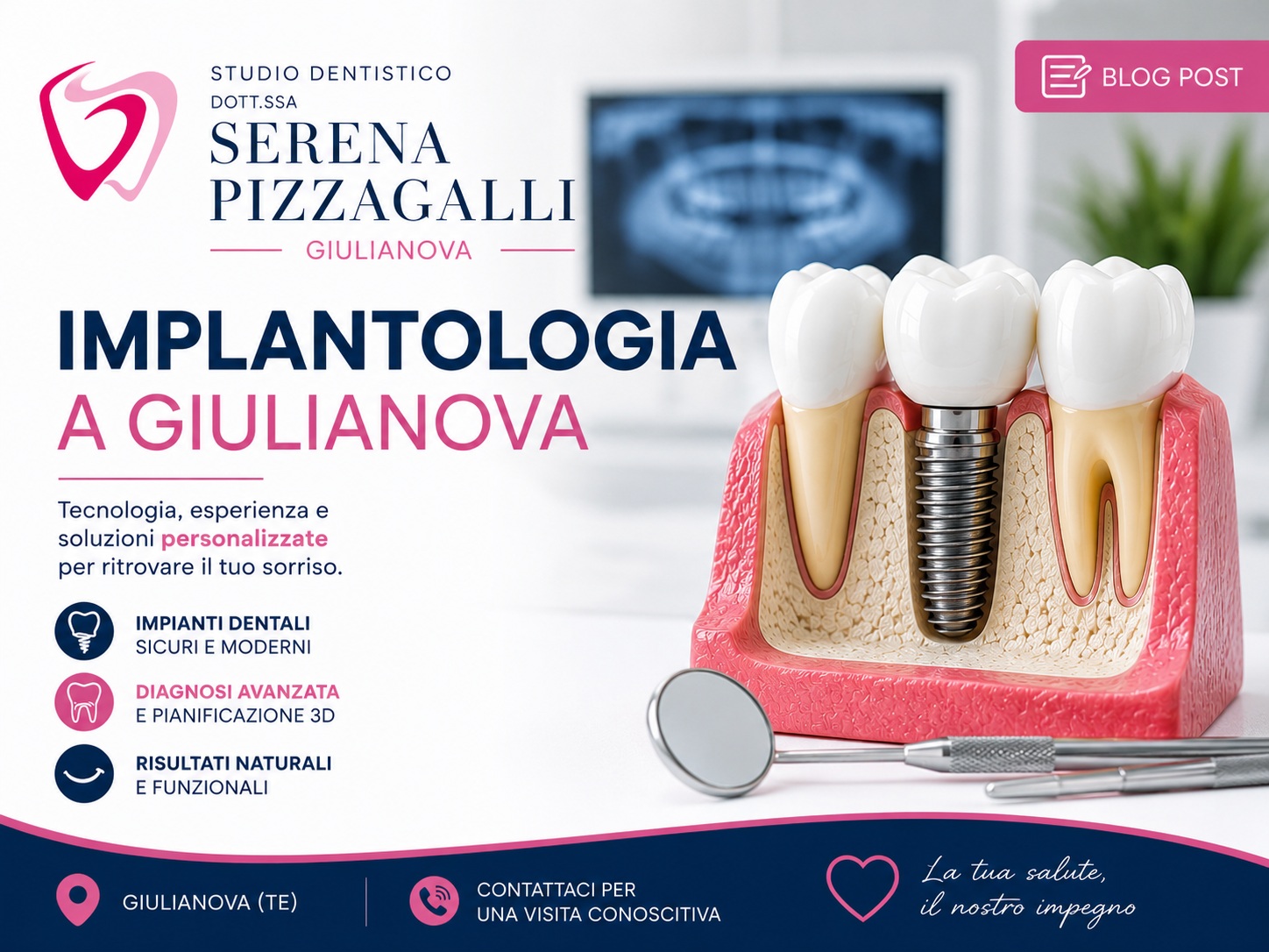 Implantologia a Giulianova