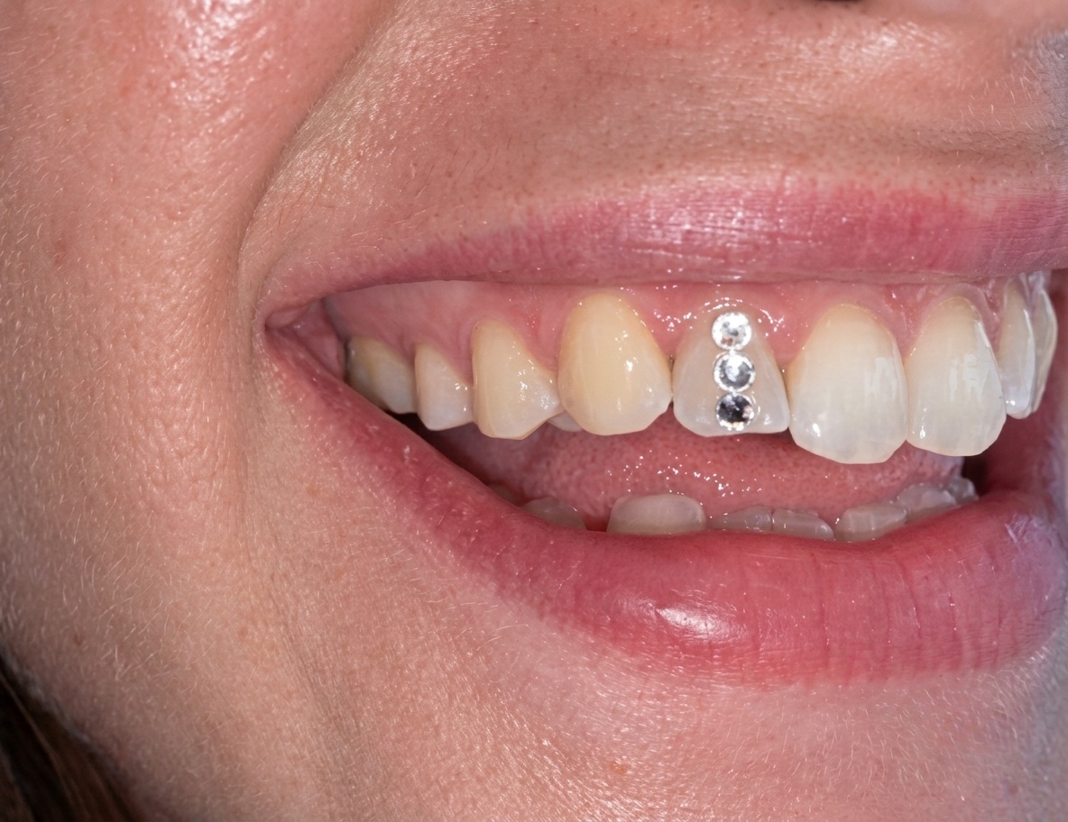 Decorazione Dentale Tooth Gem a Giulianova
