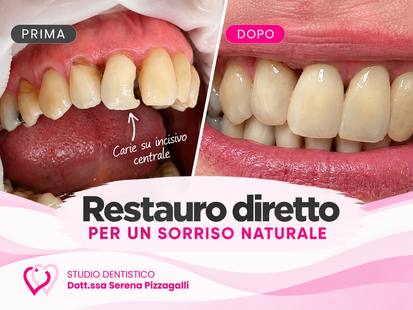 Carie su incisivo centrale: restauro diretto per ricostruire il dente in modo naturale