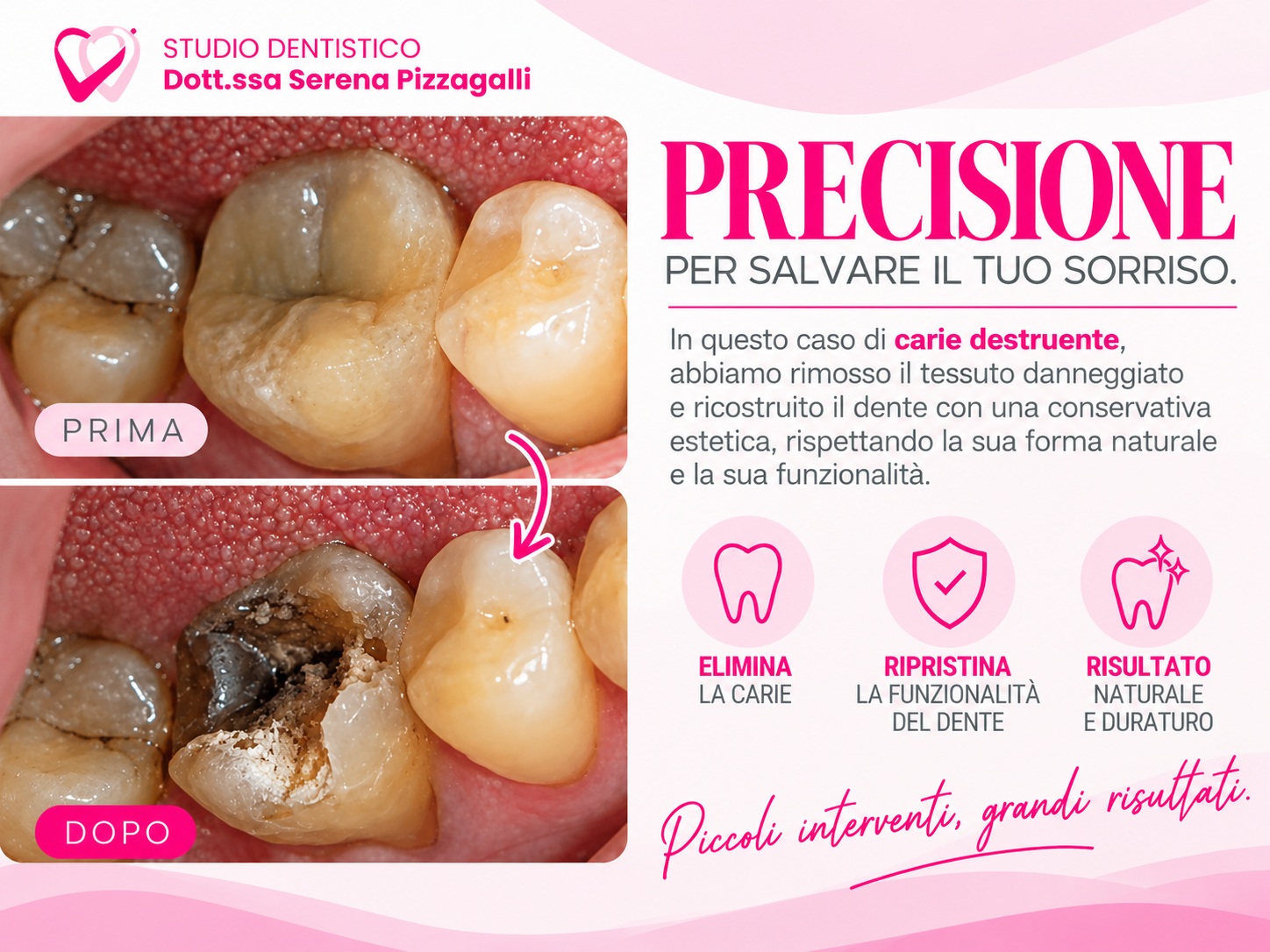 Carie dentale a Giulianova: ricostruire il dente con l’odontoiatria conservativa