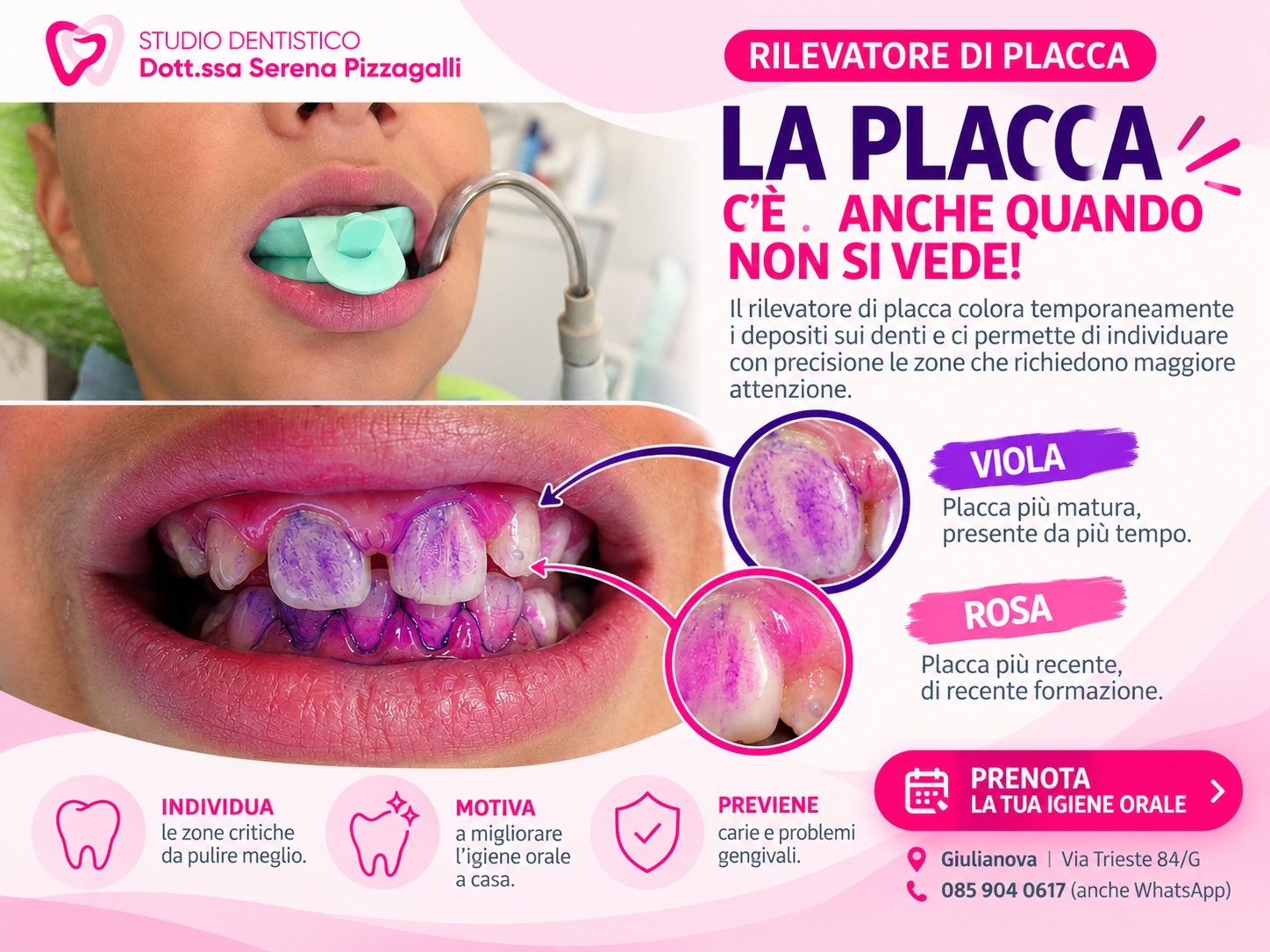 Rilevatore di placca dentale a Giulianova: vedere ciò che lo spazzolino può lasciare indietro