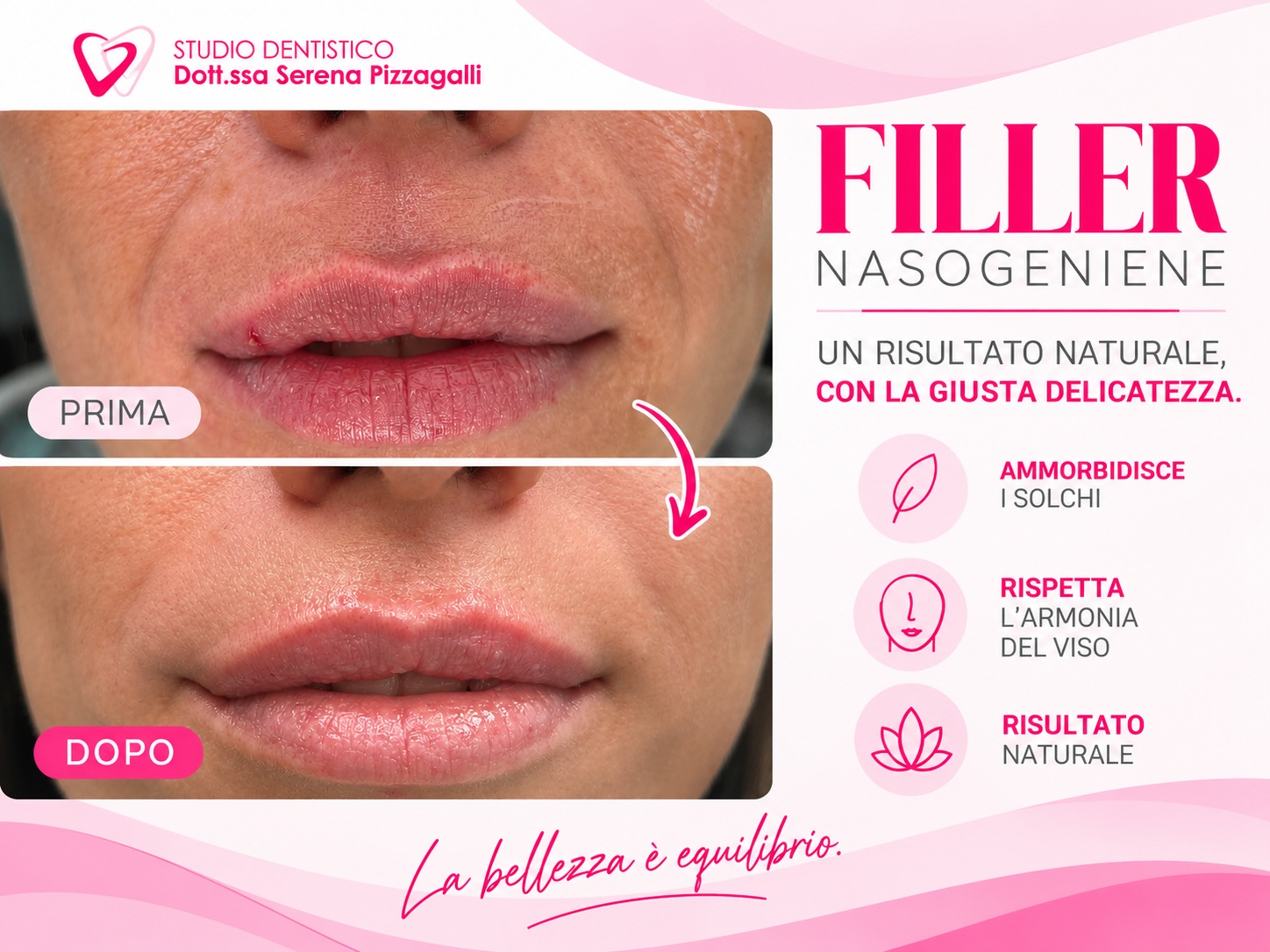 Filler nasogeniene a Giulianova: delicatezza e naturalezza | Dott.ssa Pizzagalli