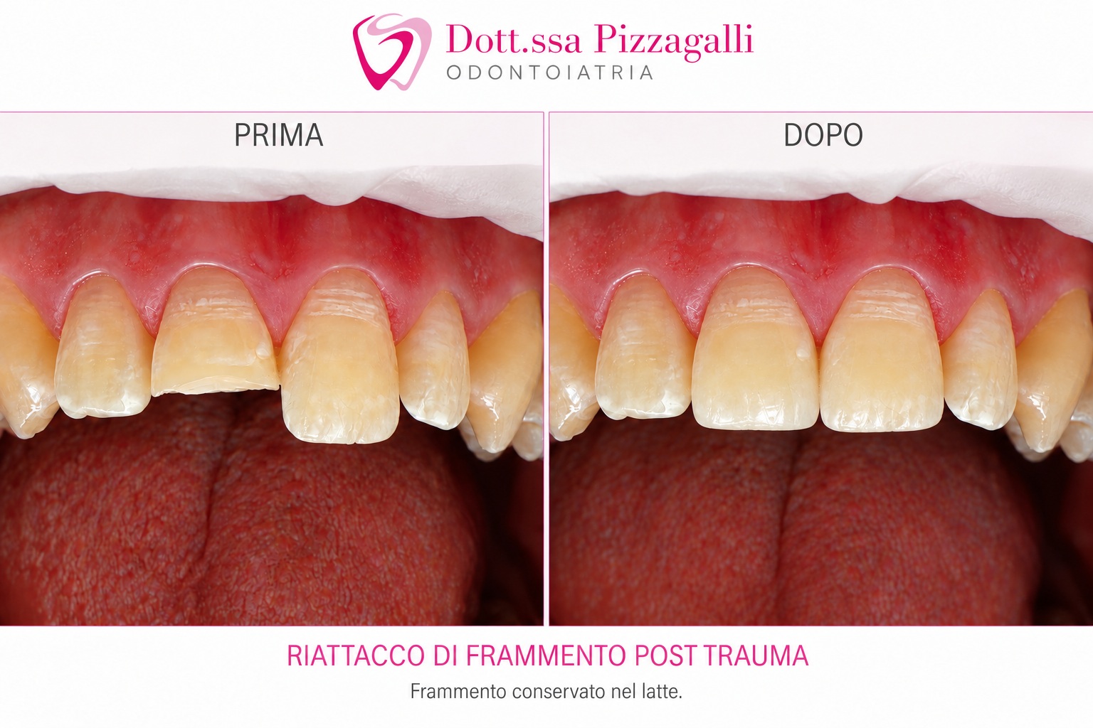 Riattacco Frammento Dente Rotto Post Trauma a Giulianova | Dott.ssa Serena Pizzagalli