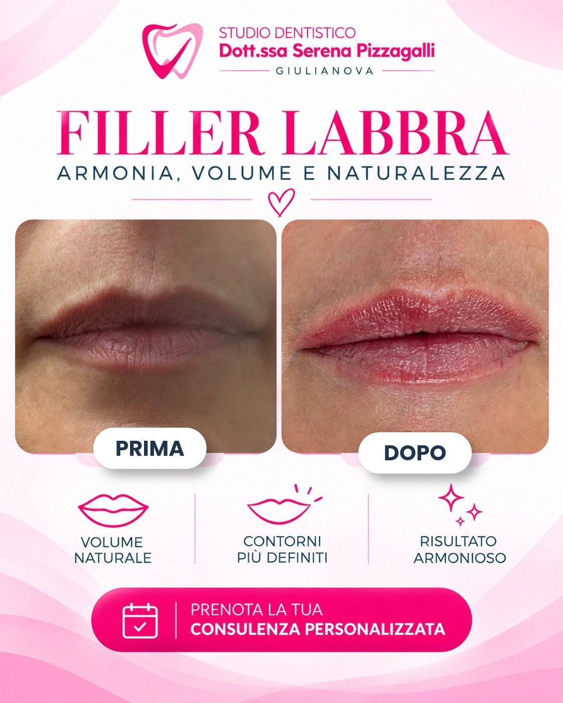 Filler Labbra Prima e Dopo a Giulianova