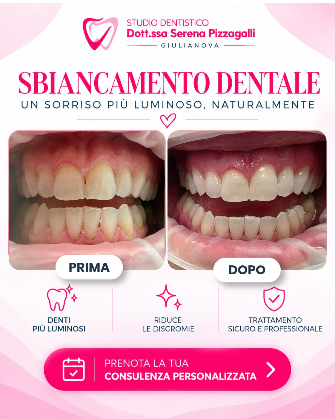 Sbiancamento Dentale a Giulianova | Dr.ssa Serena Pizzagalli